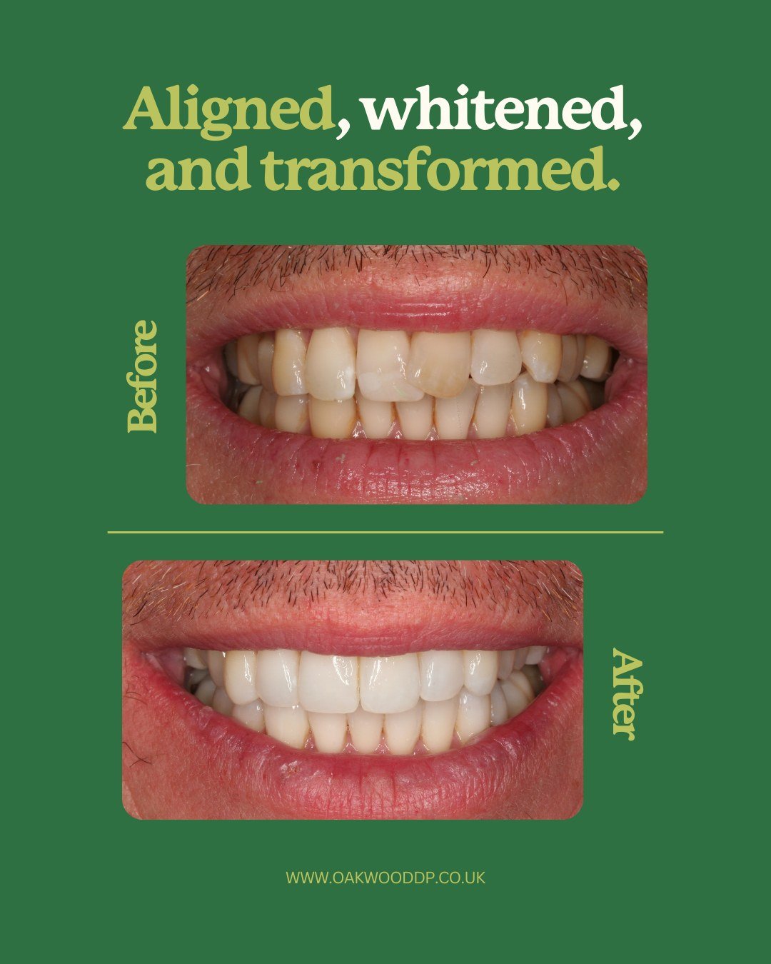 What a difference a confident smile makes! 🦷✨
This transformation is the result of a customized Invisalign journey combined with professional teeth whitening – giving our patient a straighter, brighter, and more radiant smile. It's more than just aesthetics; it's about feeling good, speaking confidently, and smiling without hesitation. Ready for your own smile glow-up? Let's make it happen!
#SmileTransformation #InvisalignJourney #TeethWhitening #BeforeAndAfter #ConfidentSmile